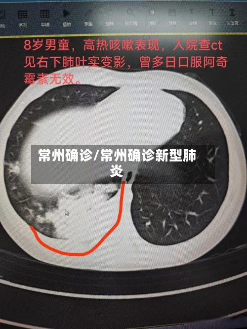 常州确诊/常州确诊新型肺炎-第2张图片